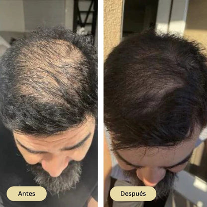 Aceite Natural Para El Crecimiento Del Cabello